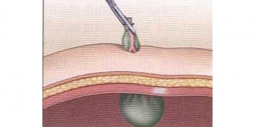 What your doctor forgot to tell you about gallbladder removal