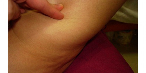 Cellulite: Plenty Of Treatments, No Cure