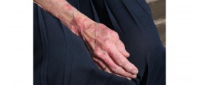 Leprosy: The nerve infection