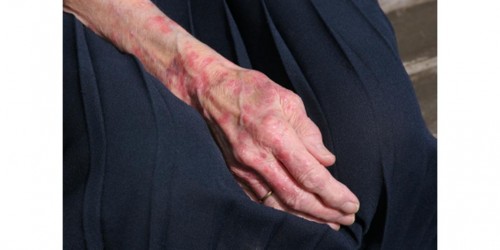 Leprosy: The nerve infection