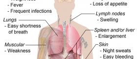 Leukemia: The Blood Cancer