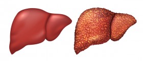 What's The Link Between Hepatitis C And Cirrhosis Of The Liver?