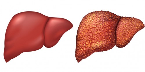 What's The Link Between Hepatitis C And Cirrhosis Of The Liver?