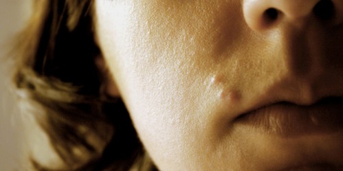 Mystery Pimple On Your Lip? Here's What It Could Be