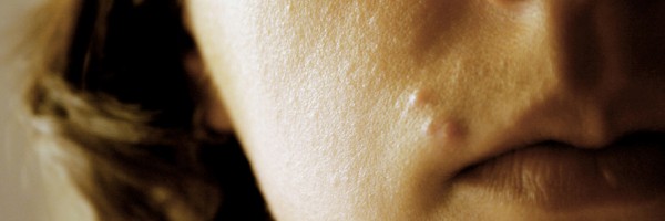 Mystery Pimple On Your Lip? Here's What It Could Be