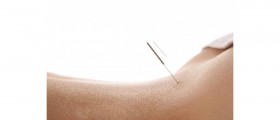 Does Acupressure Work as Well as Acupuncture?