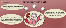 Lupus: When The Immune System Fires Against Its Own Mates