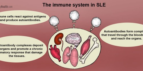 Lupus: When The Immune System Fires Against Its Own Mates