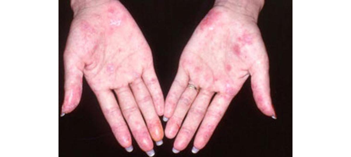 Lupus Skin Rash Disease