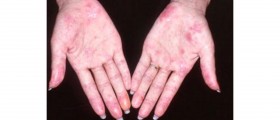Systemic lupus erythematosus (SLE)
