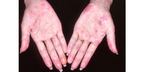 Systemic lupus erythematosus (SLE)
