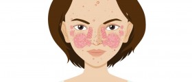 Lupus Vs Arthritis: What Are The Similarities And Differences?