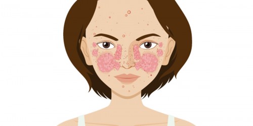 Lupus Vs Arthritis: What Are The Similarities And Differences?