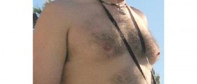 Enlarged Male Breasts: Solution for Gynecomastia
