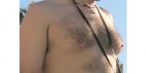 Enlarged Male Breasts: Solution for Gynecomastia