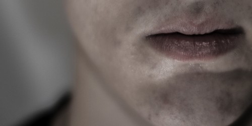 Extramammary Paget Disease: The Cancer That Starts As An Itch