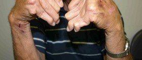 Arthritis And Platelet-Rich Plasma Treatment