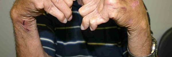 Arthritis And Platelet-Rich Plasma Treatment