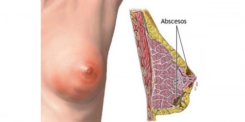 Breast infections - How to prevent mastitis?