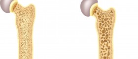 Menopause And Osteoporosis: What Every Menopausal Woman Should Know To Boost Her Bone Health