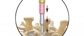 Discectomy: Pros & Cons