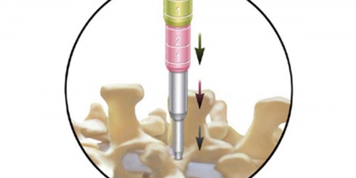 Discectomy: Pros & Cons