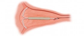 Intrauterine Devices: A Contraceptive Option More Women Should Consider