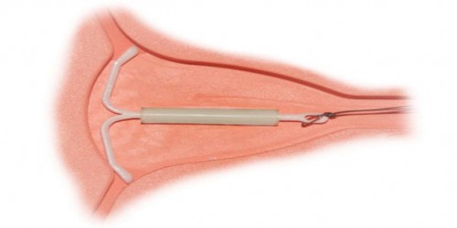 Intrauterine Devices: A Contraceptive Option More Women Should Consider