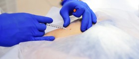 Mole removal