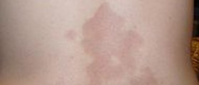 Morphea Scleroderma
