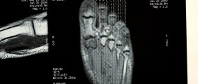 Morton's Neuroma: Symptoms & Treatment