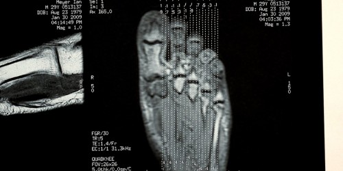 Morton's Neuroma: Symptoms & Treatment