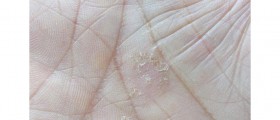 The Ten Most Common Psoriasis Triggers
