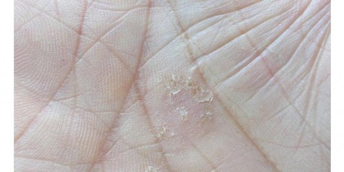 The Ten Most Common Psoriasis Triggers