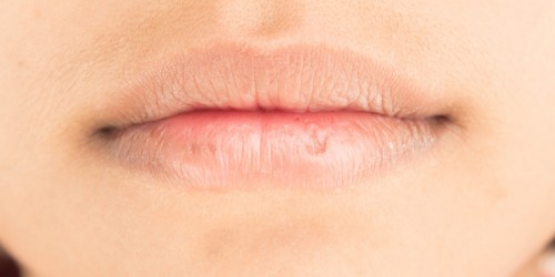 Mouth Conditions And Arthritis: Is It Sjögren’s Syndrome?