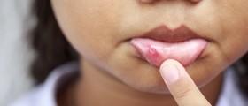 Mouth Ulcers In Children: Causes, Symptoms, And Treatment