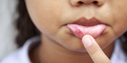 Mouth Ulcers In Children: Causes, Symptoms, And Treatment
