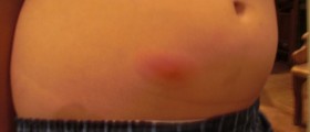 MRSA (Methicillin-resistant Staphylococcus aureus): Symptoms and treatment