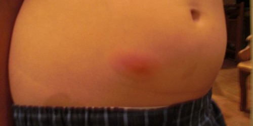 MRSA (Methicillin-resistant Staphylococcus aureus): Symptoms and treatment