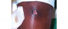 MRSA - Methicillin Resistant Staphylococcus Aureus Fact sheet