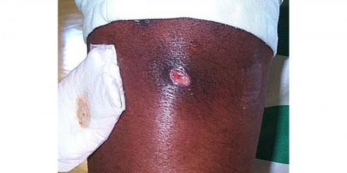 MRSA - Methicillin Resistant Staphylococcus Aureus Fact sheet