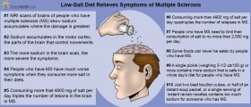 Sodium Buildup In Brain Linked To MS