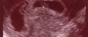 Selective Reduction For Multifetal Pregnancies: What You Need To Know