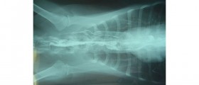 Myasthenia Gravis: Symptoms and Treatment of a Muscular Disorder