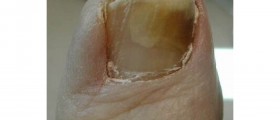 Nail Fungus Treatment