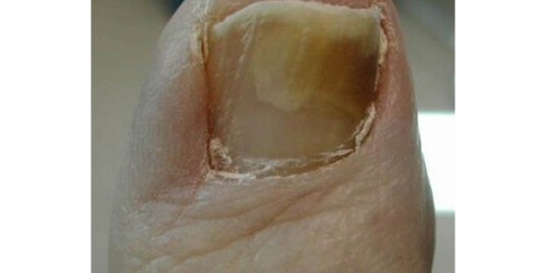 Nail Fungus Treatment