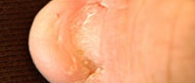 Nail Patella syndrome