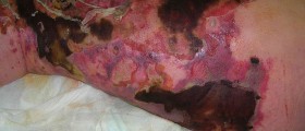 Necrotizing Fasciitis: Flesh Eating Disease