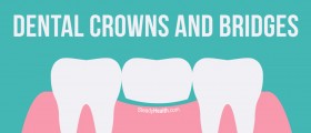 Non-implant Permanent Tooth Replacement: Dental Crowns and Bridges