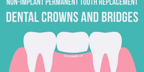 Non-implant Permanent Tooth Replacement: Dental Crowns and Bridges